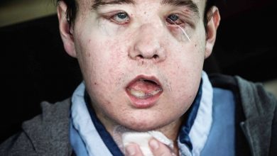 Photo of 世界首例全面移植 男病患換第三張臉