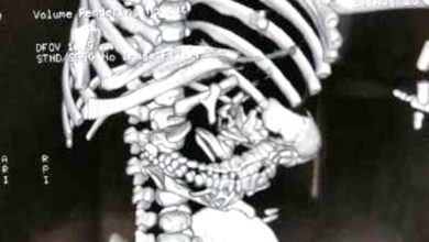 Photo of 男嬰腹中有胎 出生4天開刀切除