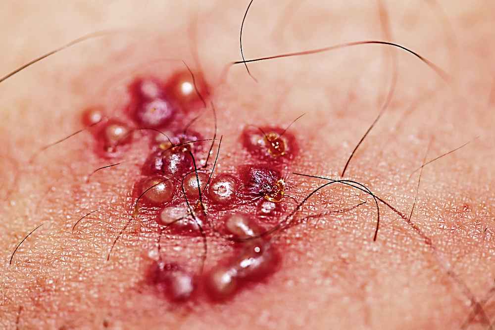 頭生蛇後中風機率高高危群須打預防針 光明日报