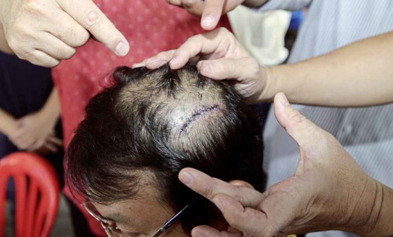 陳國光出席匯報會時突然遭人圍毆，頭上縫了11針，留下6公分長的疤痕。
