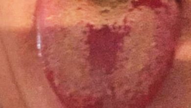 Photo of 提防草莓舌 料是新冠症狀