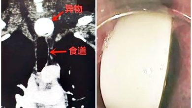 Photo of 賭氣吞棋 險食管穿孔 安全套救了他