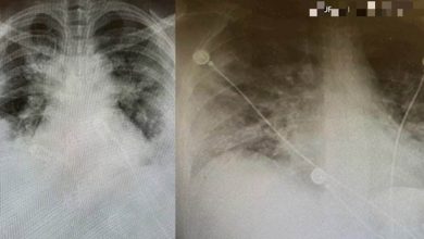 Photo of 冠病患者肺部X光大曝光! 多倫多醫生:大流行對年輕人造成嚴重傷害