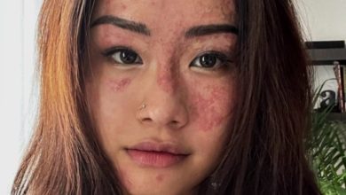 Photo of 遭滾油灼傷臉毀容  女子從燒傷中勇敢直面傷疤