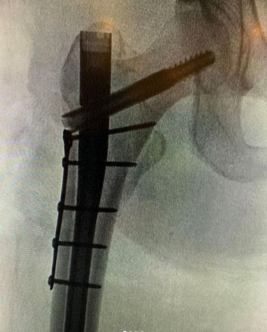 從X光照片中可見她的股骨被醫生裝上多支螺絲固定