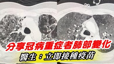 Photo of 分享冠病重症者肺部變化   醫生：立即接種疫苗