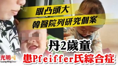 Photo of 眼凸頭大 韓醫院列研究個案    丹2歲童患Pfeiffer氏綜合症