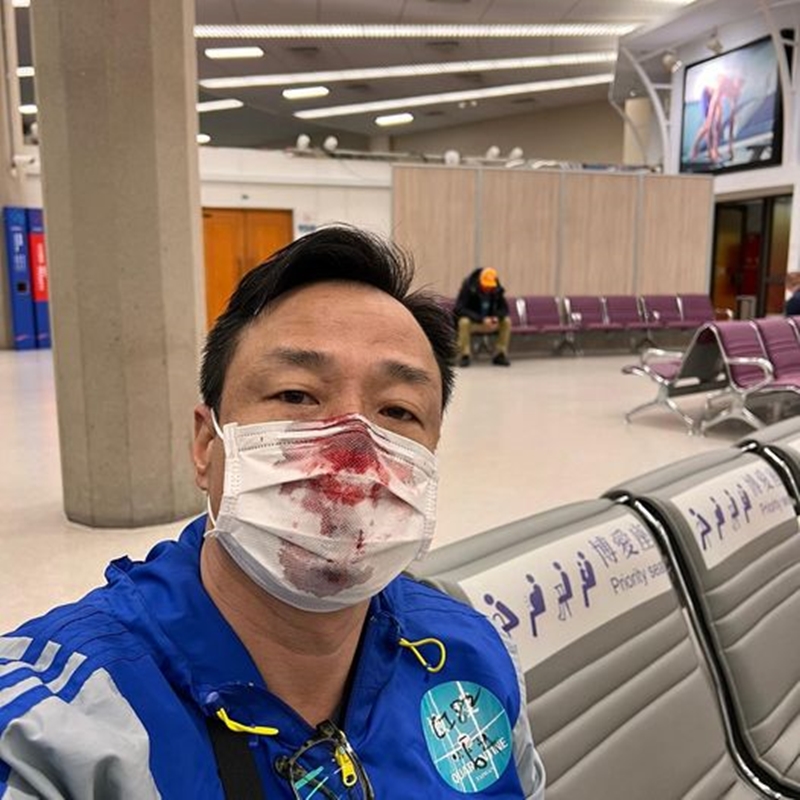 王喜歷經在桃園機場做落地檢測鼻孔受傷後，在台引起一陣熱烈討論