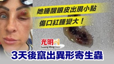 Photo of 她睡醒眼皮出現小點 傷口紅腫變大！3天後竄出異形寄生蟲