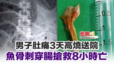 Photo of 男子肚痛3天高燒送院 魚骨刺穿腸搶救8小時亡