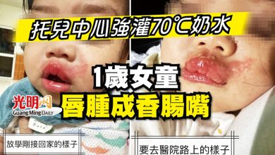 Photo of 托兒中心強灌70℃奶水 1歲女童唇腫成香腸嘴