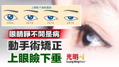 Photo of 【本地醫療】眼睛睜不開是病 動手術矯正上眼瞼下垂
