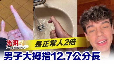 Photo of 男子大拇指12.7公分長 是正常人2倍