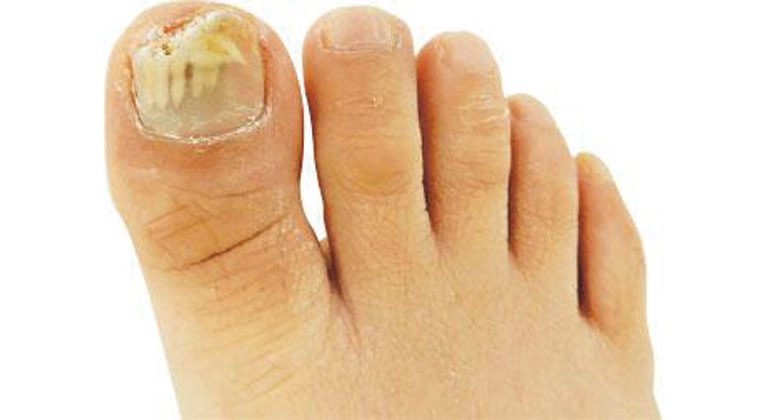 [Chinese and Western Medicine Viewpoint]Weak resistance is easy to be recruited. Wearing narrow shoes often makes manicures be careful that the nails turn gray.
