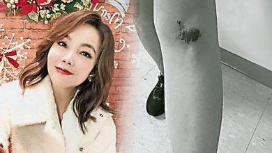 Photo of 被阿伯不偏不倚砸中 辛曉琪變肉墊膝蓋傷
