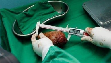 Photo of 斯里蘭卡老兵腹痛開刀  驚見801克“世界最大腎結石”