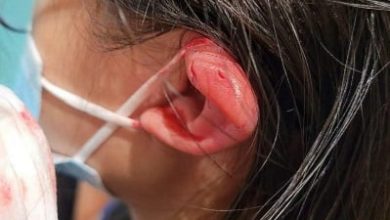 Photo of 一家四口遊飛禽公園 13歲女生被鸚鵡啄傷左耳