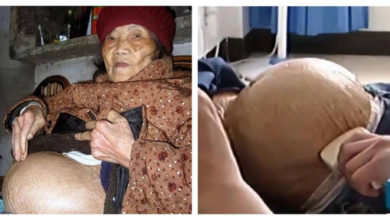 Photo of 91歲阿嬤跌倒竟懷孕？ 醫驚：肚裡有完整胎兒