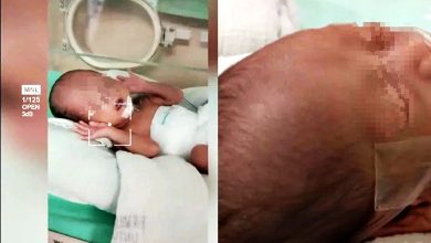 Photo of 【視頻】母控訴護士失手掉落地 早產兒頭骨裂腦出血