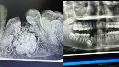 Photo of 以為缺1顆牙 23歲正妹竟長了57顆牙