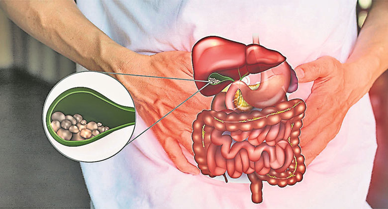 [Special Topic on Gallstones]Stones falling into the bile duct can cause pain and bloating, and gallbladder removal can prevent future complications.