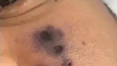 Photo of 蜘蛛咬傷臉未及時求醫 男歌手一週後喪命