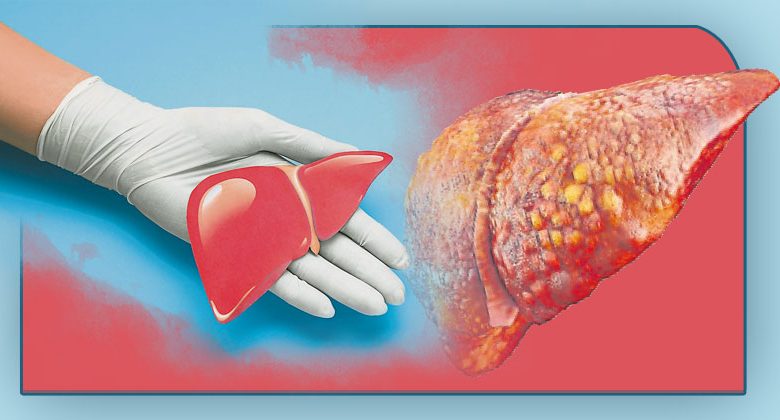 [Special Topic on Fatty Liver]Chinese people have low awareness, and 1 in 3 people suffers from fatty liver if ignored, which may turn into liver cancer.