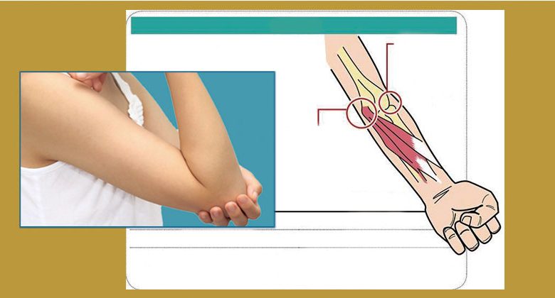 Repetitive strain injury, overexertion, clerk and housewife also suffer from tennis elbow