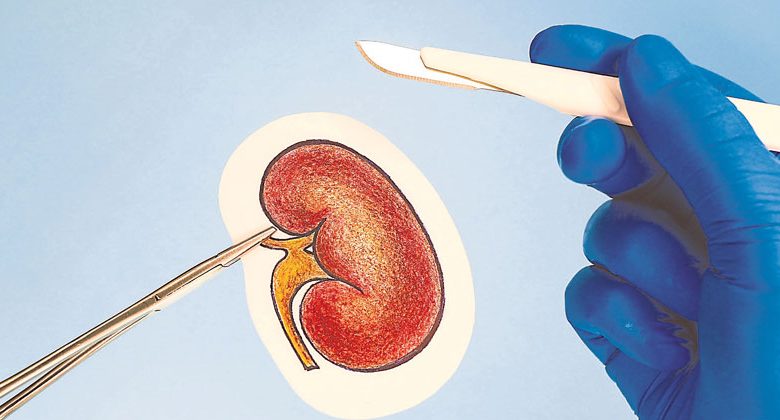 [Kidney Transplantation Special Topic]The survival rate of transplanted kidneys is high without dialysis treatment three times a week