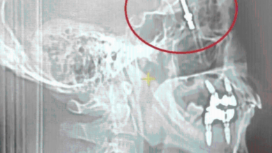 Photo of 螺絲釘插穿頭骨直達大腦 牙醫:我保證這是正常的