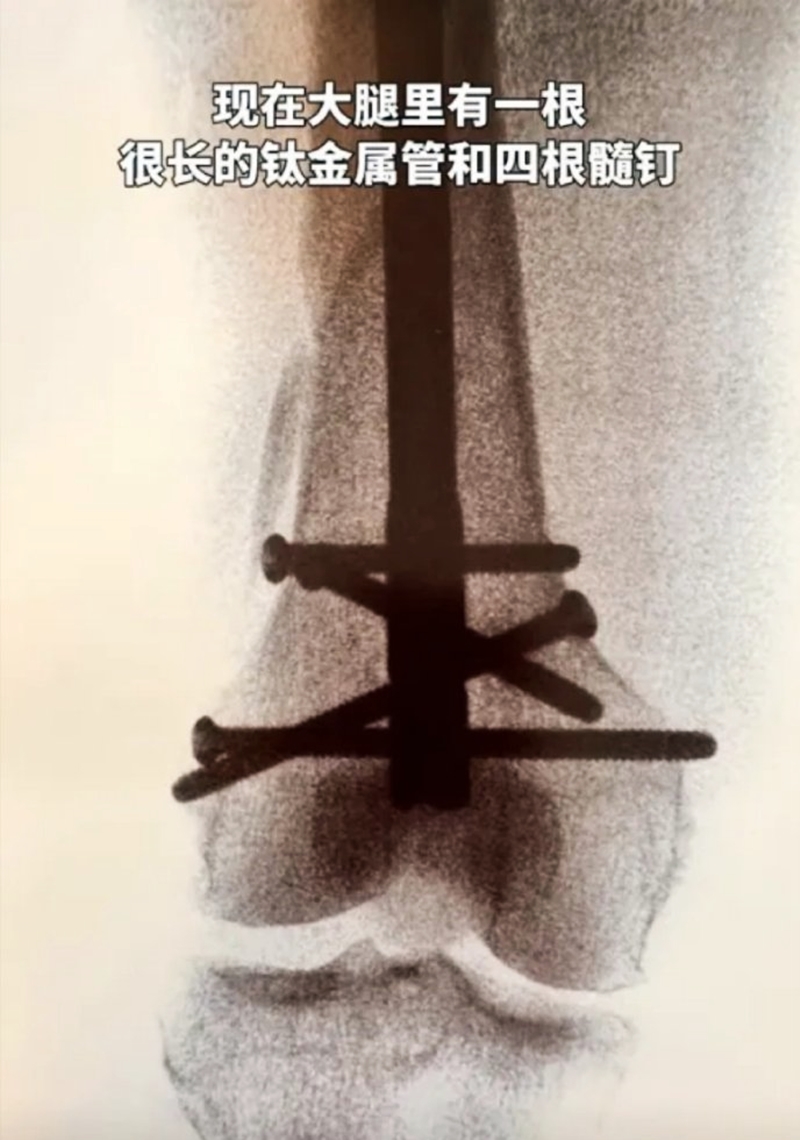 陳嵐的大腿裡有很長的一根鈦金屬管和4根髓釘。