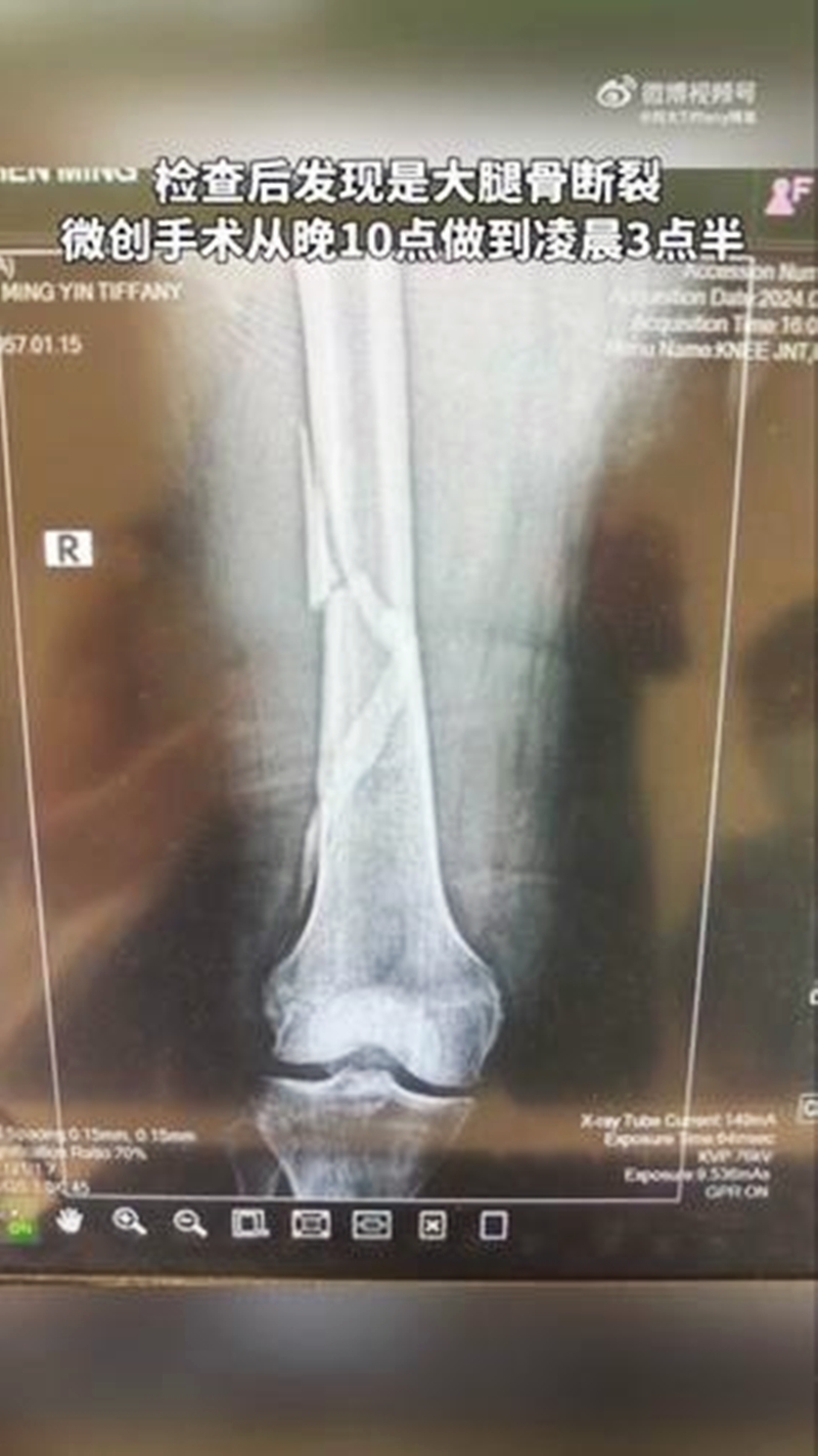 送醫被診斷出大腿骨斷裂