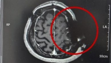 Photo of 老婦腦瘤手術留鋸片 醫生辯稱常發生