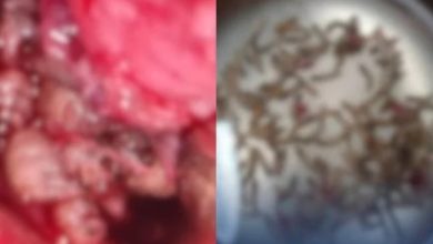 Photo of 女子鼻血流一週 從鼻腔挖出逾百蛆蟲