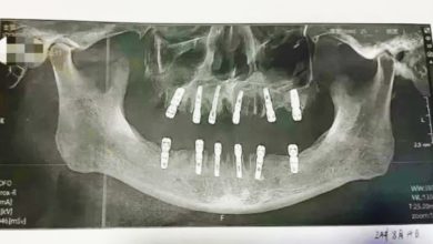 Photo of 男子一次性拔23牙再種12顆 13天後去世當局調查