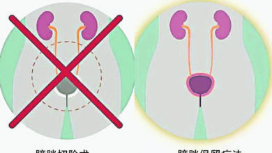 Photo of 【中西醫觀點】保膀胱治癌存活率高  三聯療法勝過手術切除