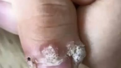 Photo of 指缝长菜花 女子感染HPV!