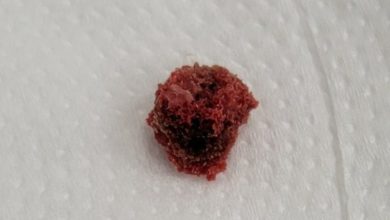 Photo of 男孩流黄鼻涕带血丝 医生竟夹出这东西!