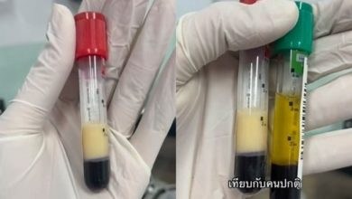 Photo of 酗酒男全身瘫软急送院 血清如炼乳