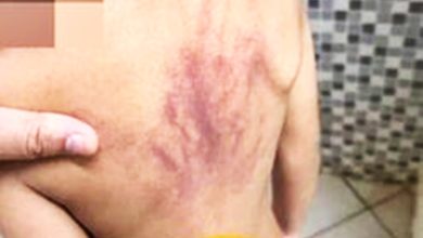Photo of 托儿所返家  背有瘀伤 父控訴自闭兒被虐 警：缺证据不续查
