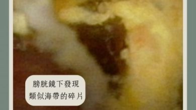 Photo of 患者长期便秘尿出海带 医惊呆: 膀胱有玉米和蛋花