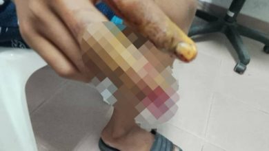 Photo of 玩球状鞭炮 少年中指被炸断