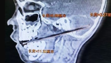 Photo of 边吃麦芽糖边玩摔倒 11公分竹签贯穿男童颅底