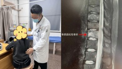 Photo of 每天4杯咖啡 25岁女子弯腰竟骨折
