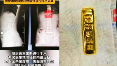 Photo of 11岁童误吞金条急送医 卡腹2天动手术取出
