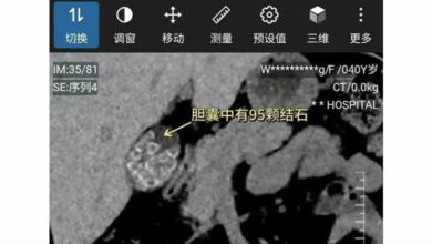 Photo of 深夜吃宵夜不吃早餐 女子体内有95颗结石