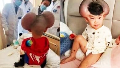 Photo of 罹罕见病！头长巨痣被嘲“米奇” 3岁童手术成功终于笑了
