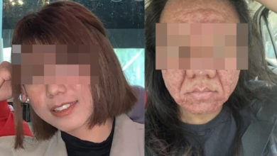 Photo of “我变成另一个人！” 怀孕后面容巨变女子崩溃