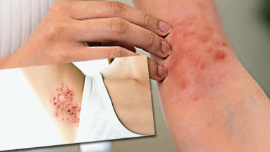 Photo of 貌似痘痘发炎流脓 化脓性汗腺炎治疗解析