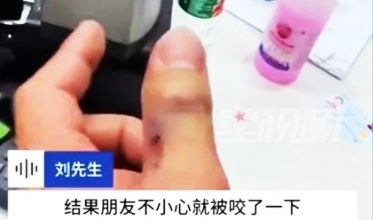 Photo of 男子好奇抓短尾蝮蛇被咬 手肿胀发黑急送医